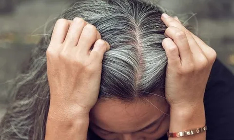 Những thực phẩm quen thuộc gây bạc tóc, hói đầu sớm
